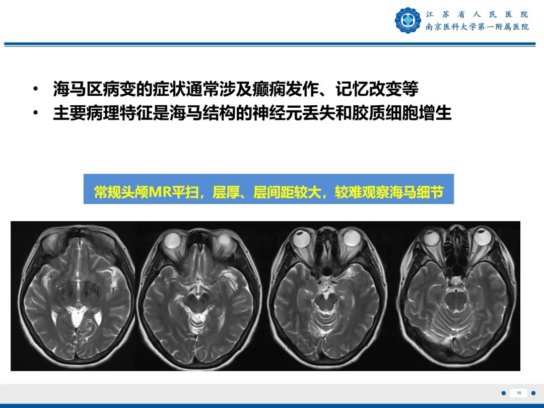 影像PPT - 【PPT】​海马硬化-13