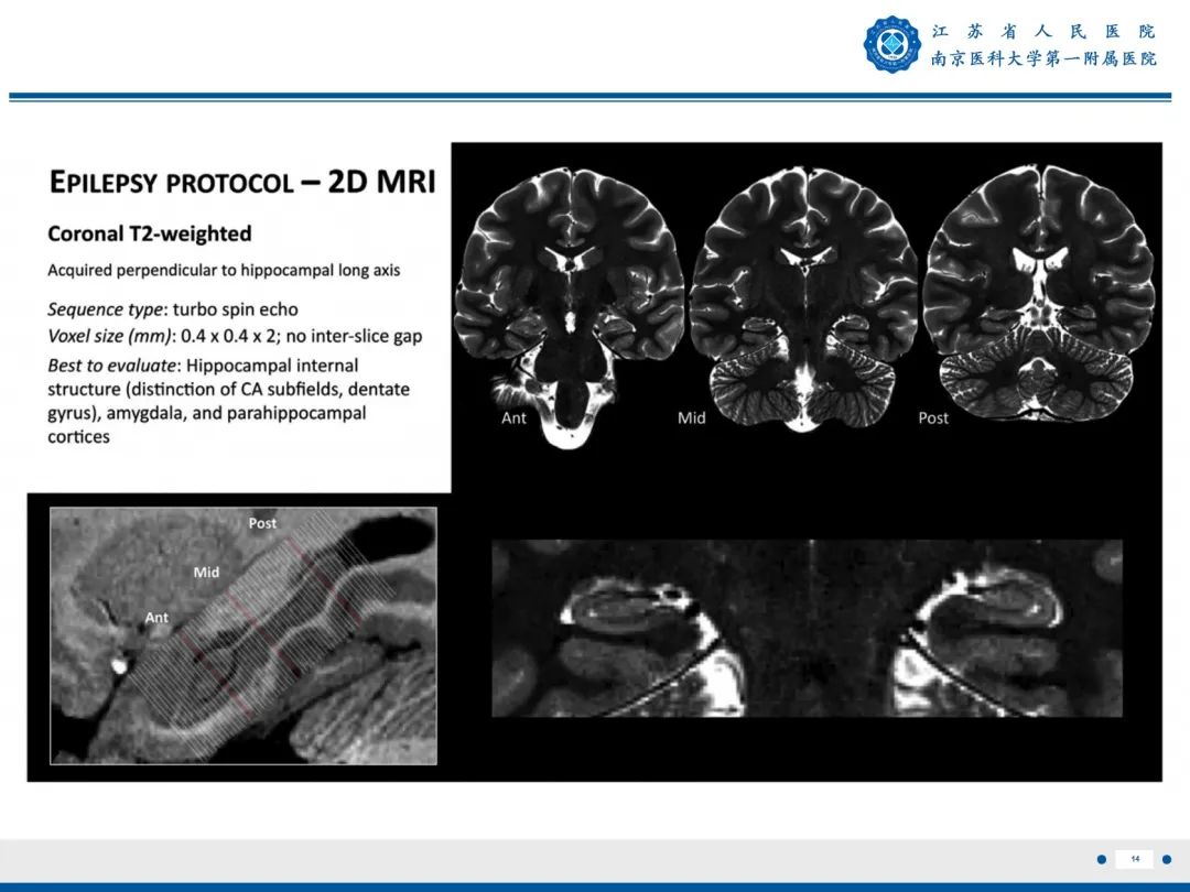 影像PPT - 【PPT】​海马硬化-15
