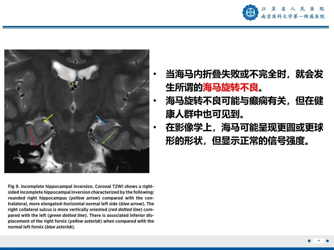 影像PPT - 【PPT】​海马硬化-19