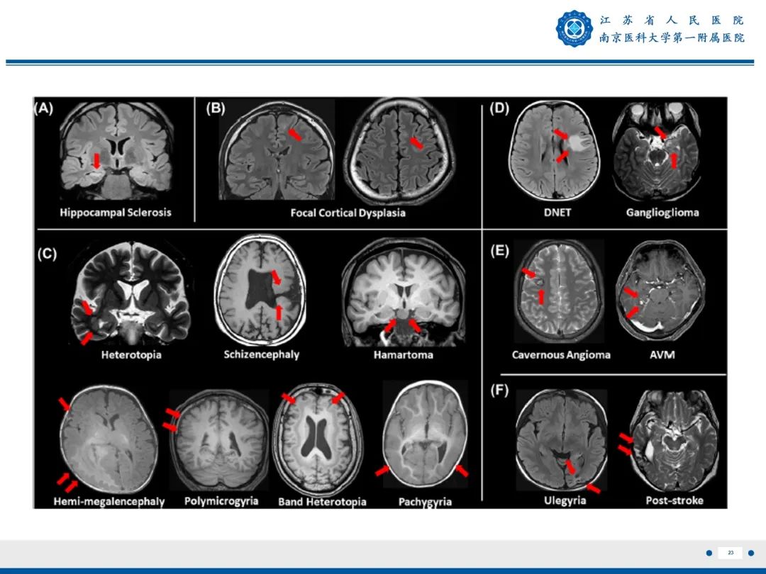 影像PPT - 【PPT】​海马硬化-24