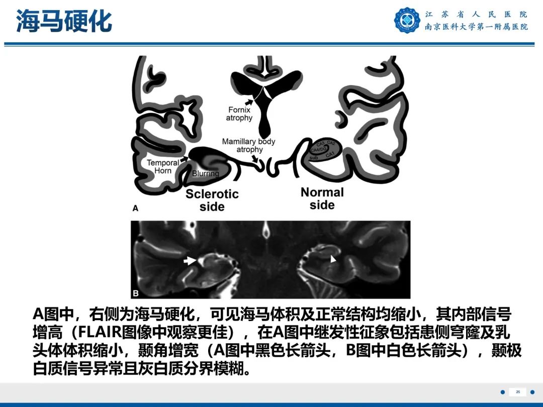 影像PPT - 【PPT】​海马硬化-26