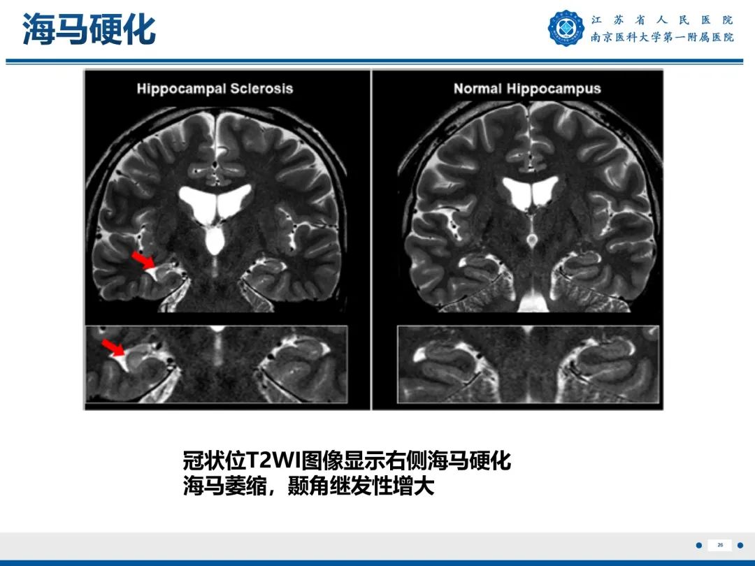 影像PPT - 【PPT】​海马硬化-27
