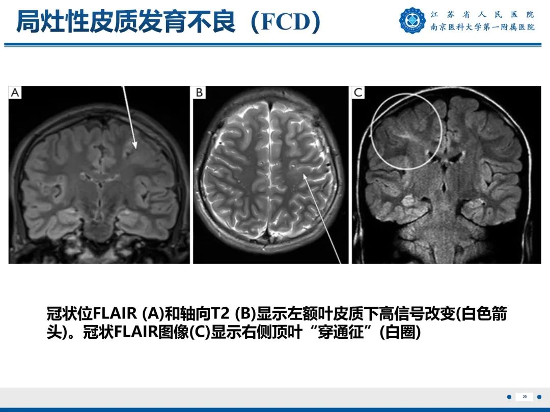 影像PPT - 【PPT】​海马硬化-30
