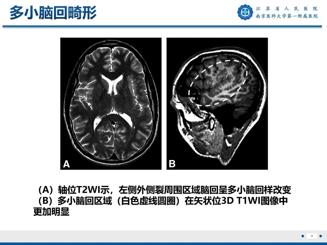 影像PPT - 【PPT】​海马硬化-32