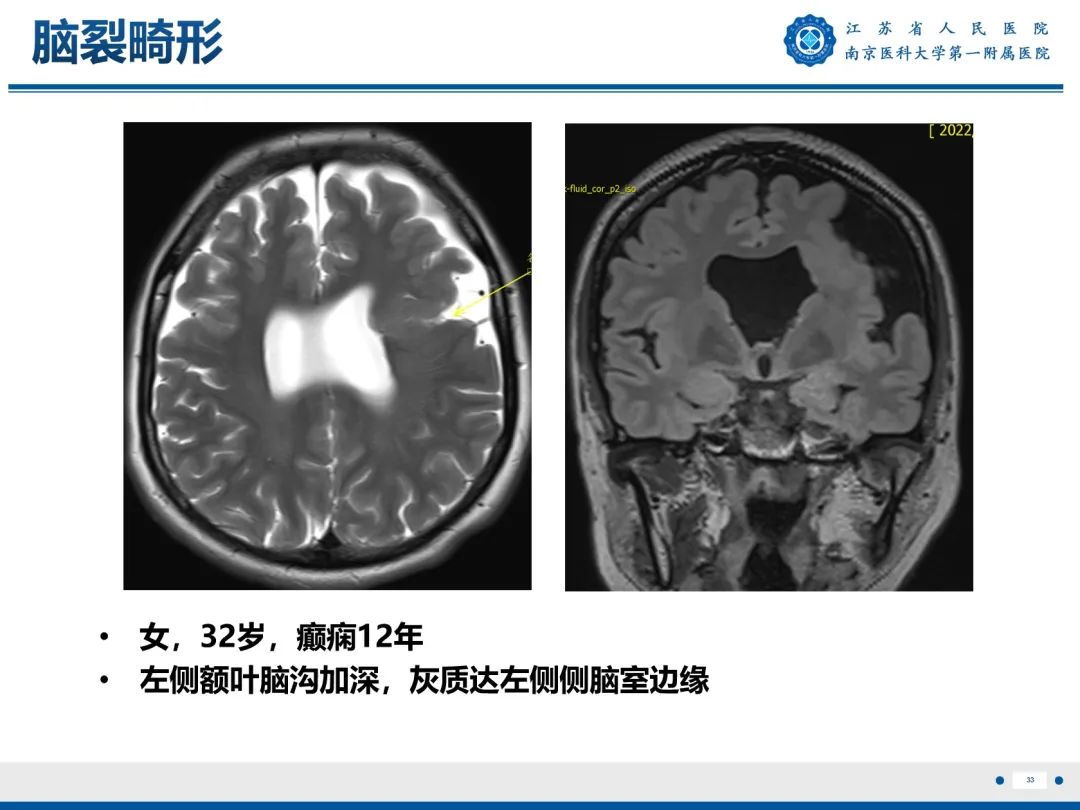 影像PPT - 【PPT】​海马硬化-34