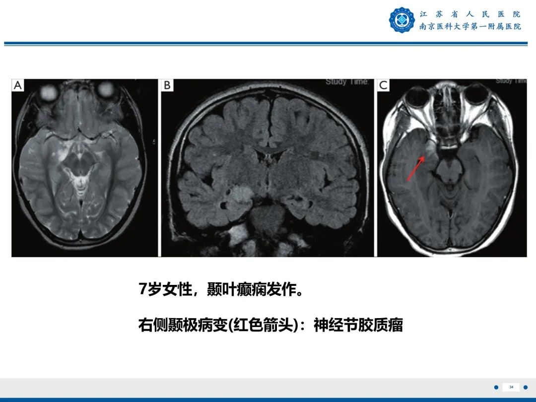 影像PPT - 【PPT】​海马硬化-35