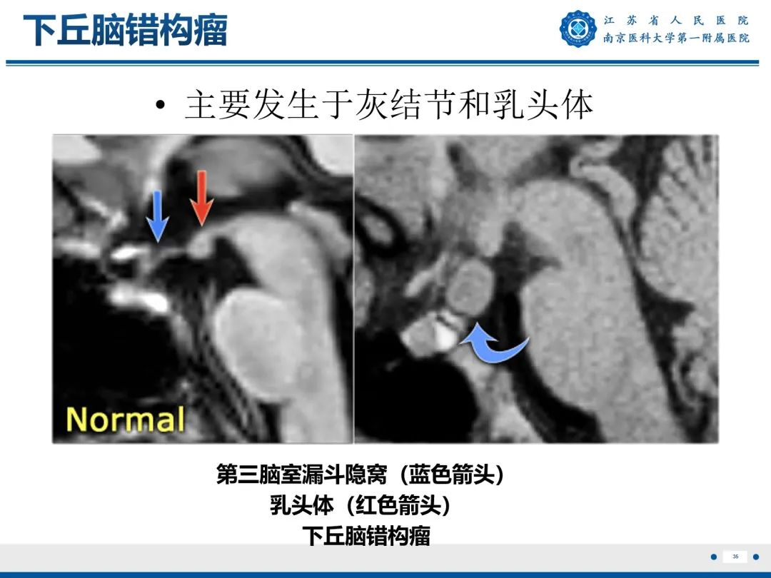影像PPT - 【PPT】​海马硬化-36