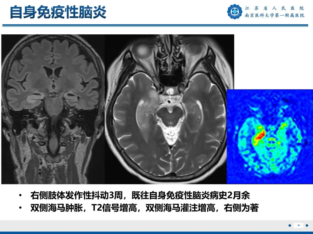 影像PPT - 【PPT】​海马硬化-37