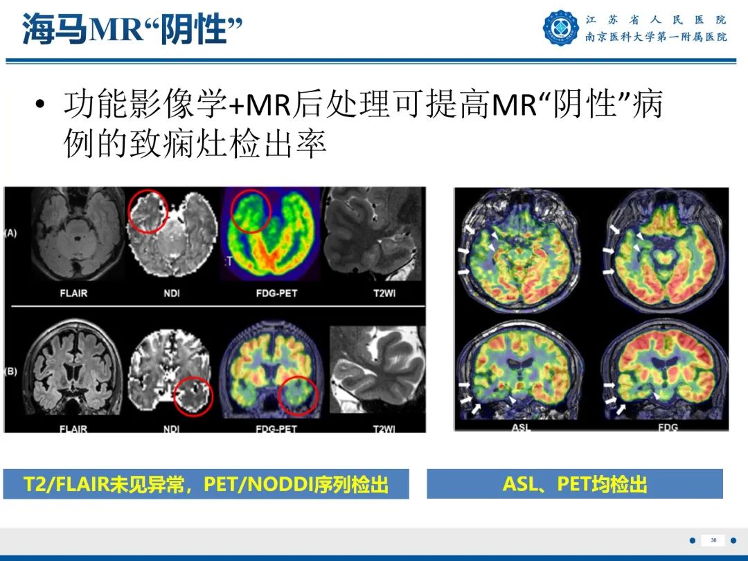 影像PPT - 【PPT】​海马硬化-39