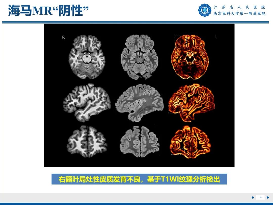 影像PPT - 【PPT】​海马硬化-40