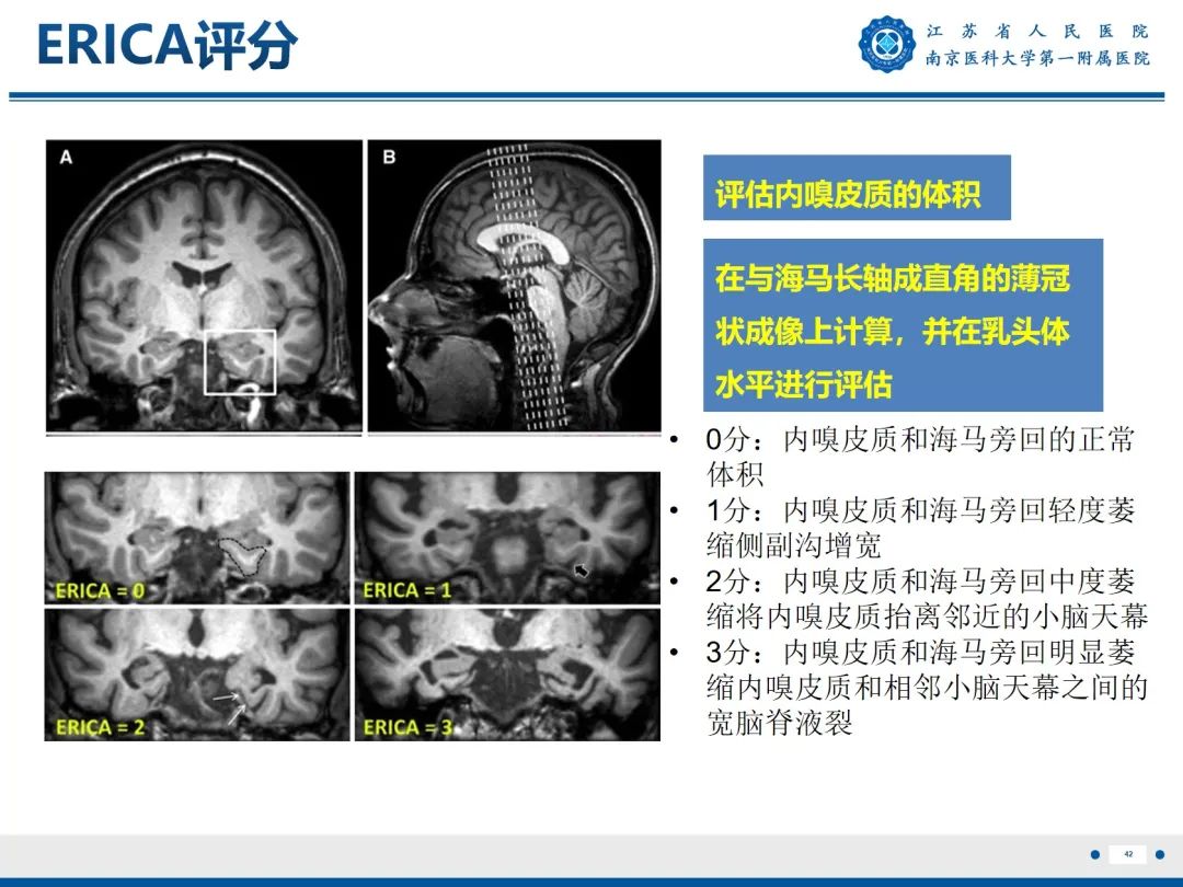 影像PPT - 【PPT】​海马硬化-43