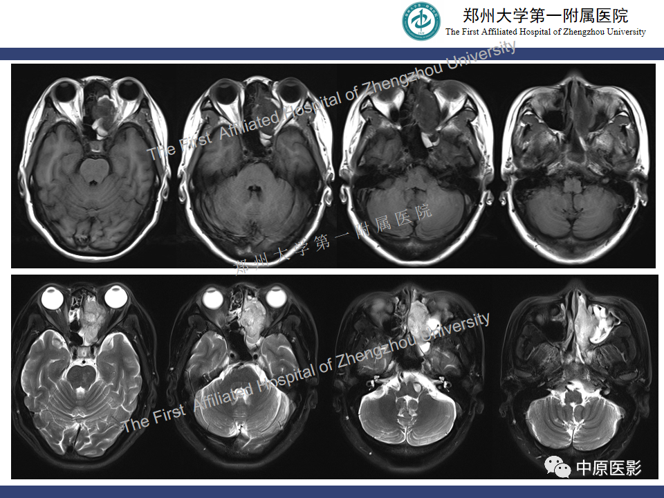 影像PPT - 【病例】鼻窦肌上皮癌1例MR影像-3