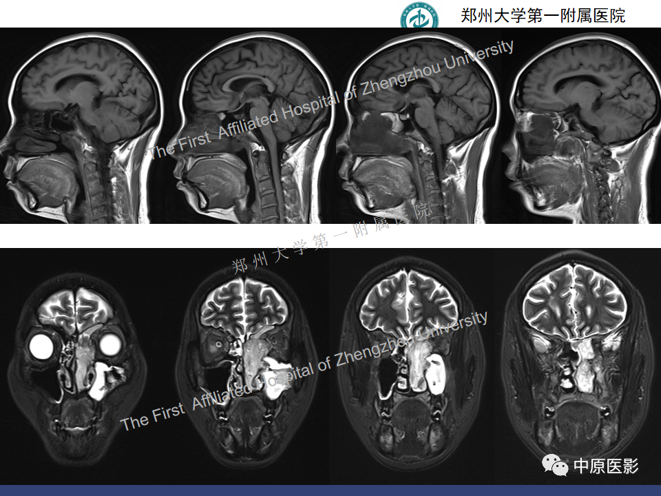 影像PPT - 【病例】鼻窦肌上皮癌1例MR影像-5