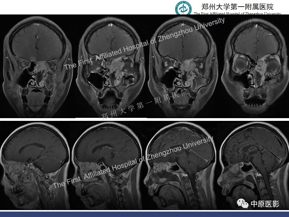 影像PPT - 【病例】鼻窦肌上皮癌1例MR影像-6