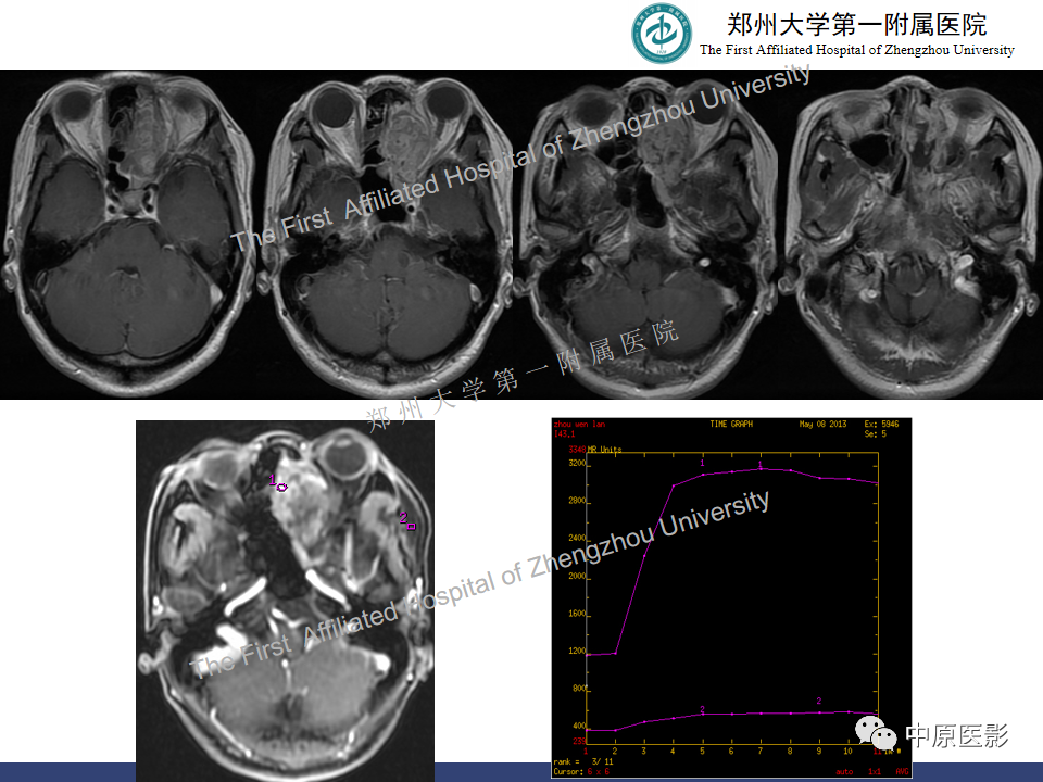 影像PPT - 【病例】鼻窦肌上皮癌1例MR影像-7