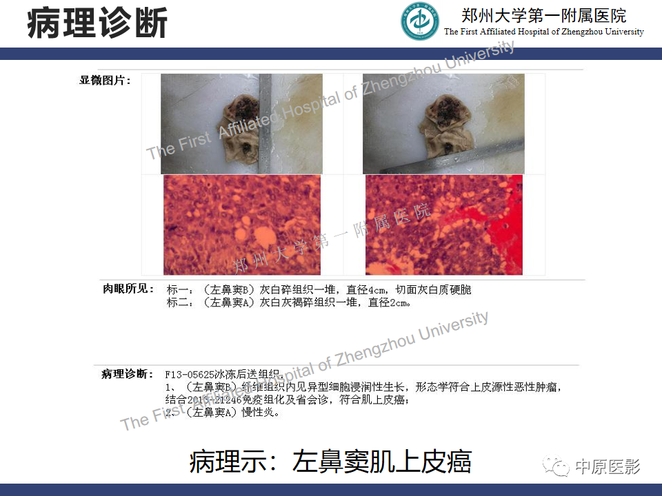 影像PPT - 【病例】鼻窦肌上皮癌1例MR影像-10