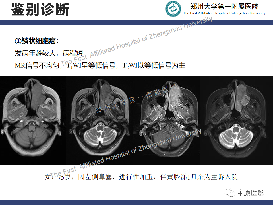 影像PPT - 【病例】鼻窦肌上皮癌1例MR影像-17