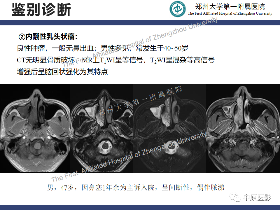 影像PPT - 【病例】鼻窦肌上皮癌1例MR影像-18