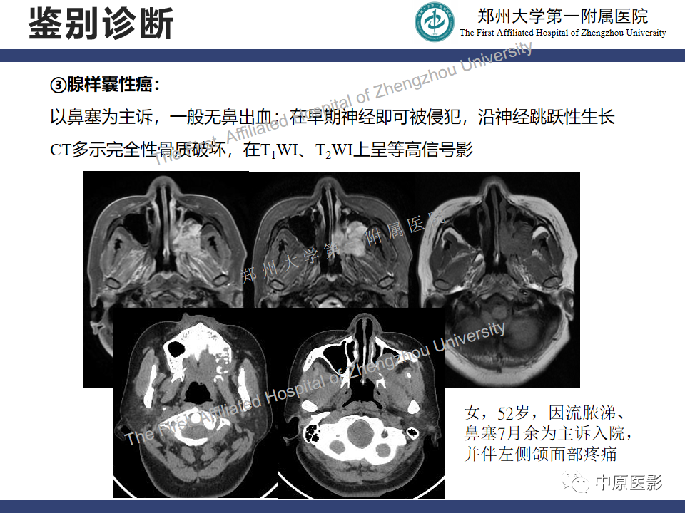 影像PPT - 【病例】鼻窦肌上皮癌1例MR影像-19