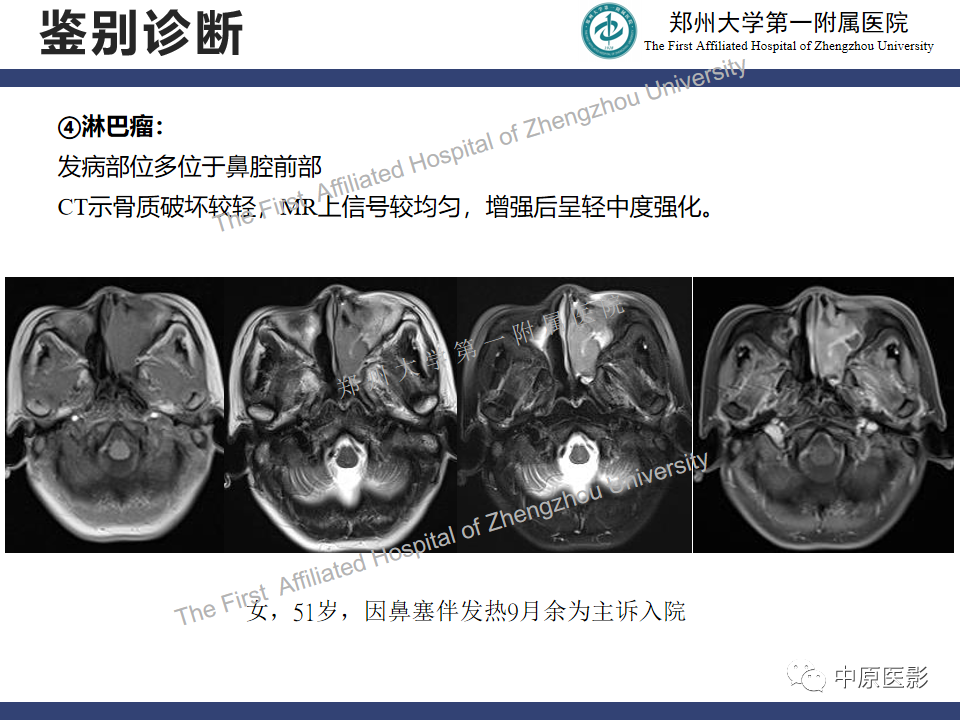 影像PPT - 【病例】鼻窦肌上皮癌1例MR影像-20