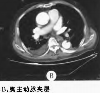 影像PPT - 急性主动脉夹层的临床特征和影像学-21 影像PPT - 急性主动脉夹层的临床特征和影像学-21
