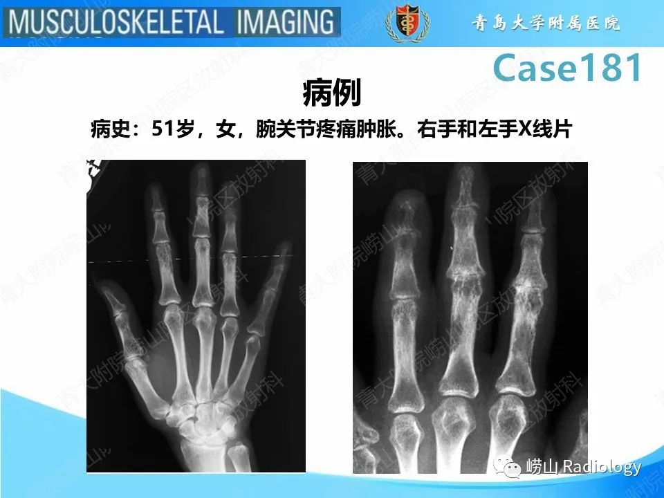 影像PPT - 【PPT】结节病性关节病-2