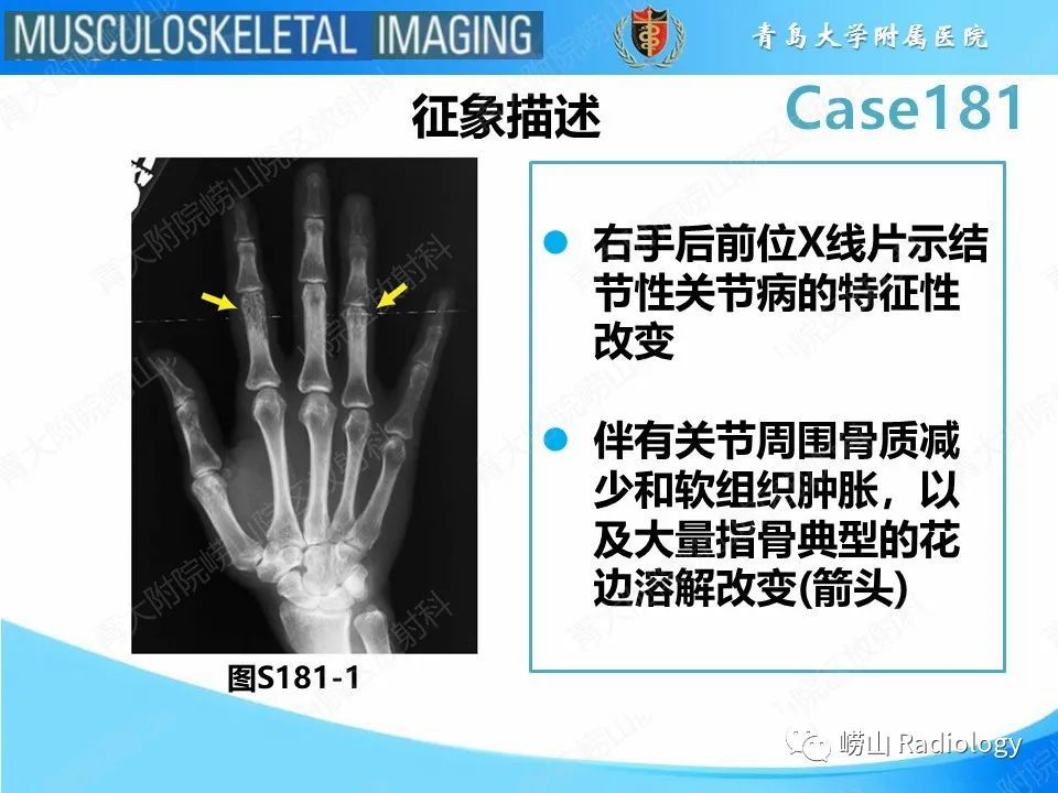 影像PPT - 【PPT】结节病性关节病-14