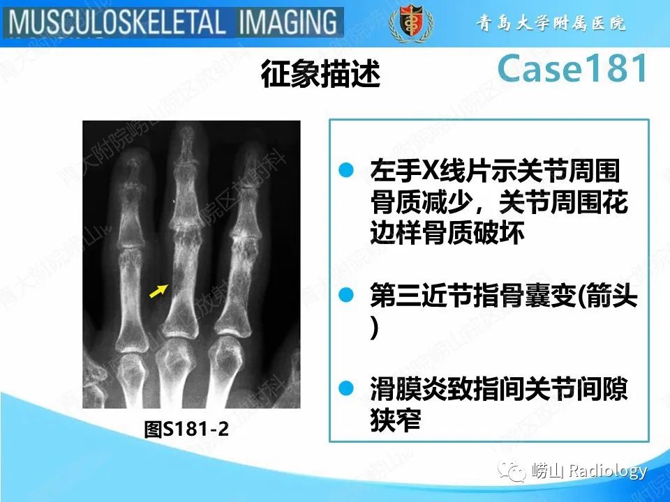 影像PPT - 【PPT】结节病性关节病-15
