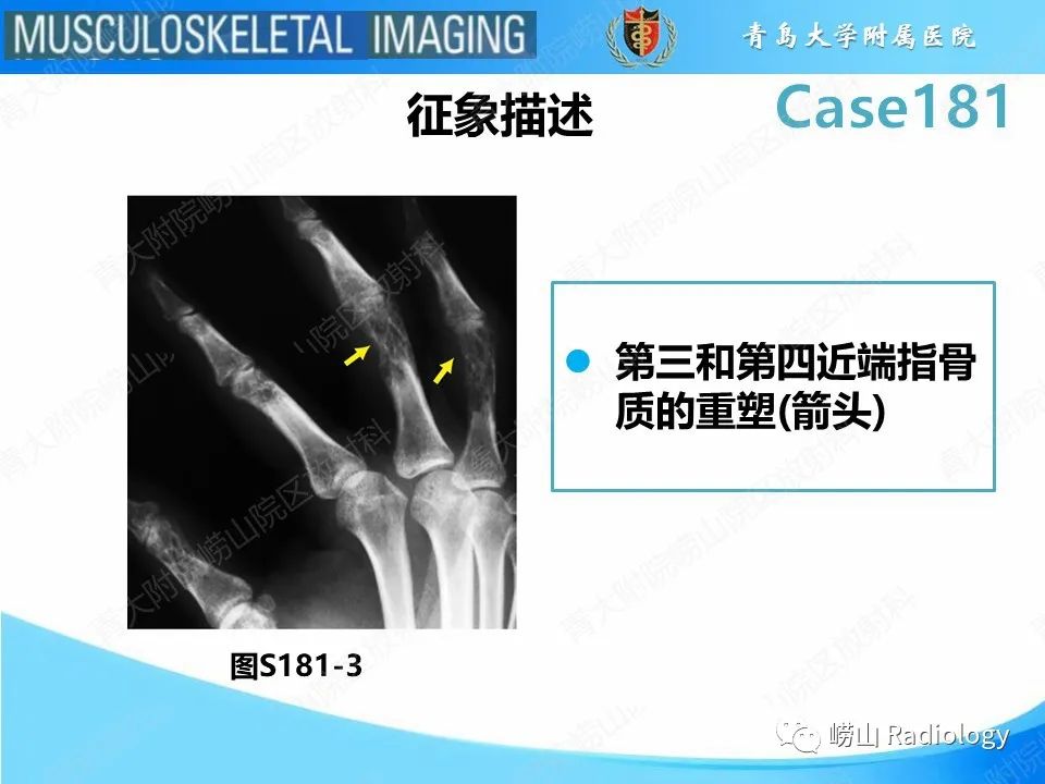 影像PPT - 【PPT】结节病性关节病-16