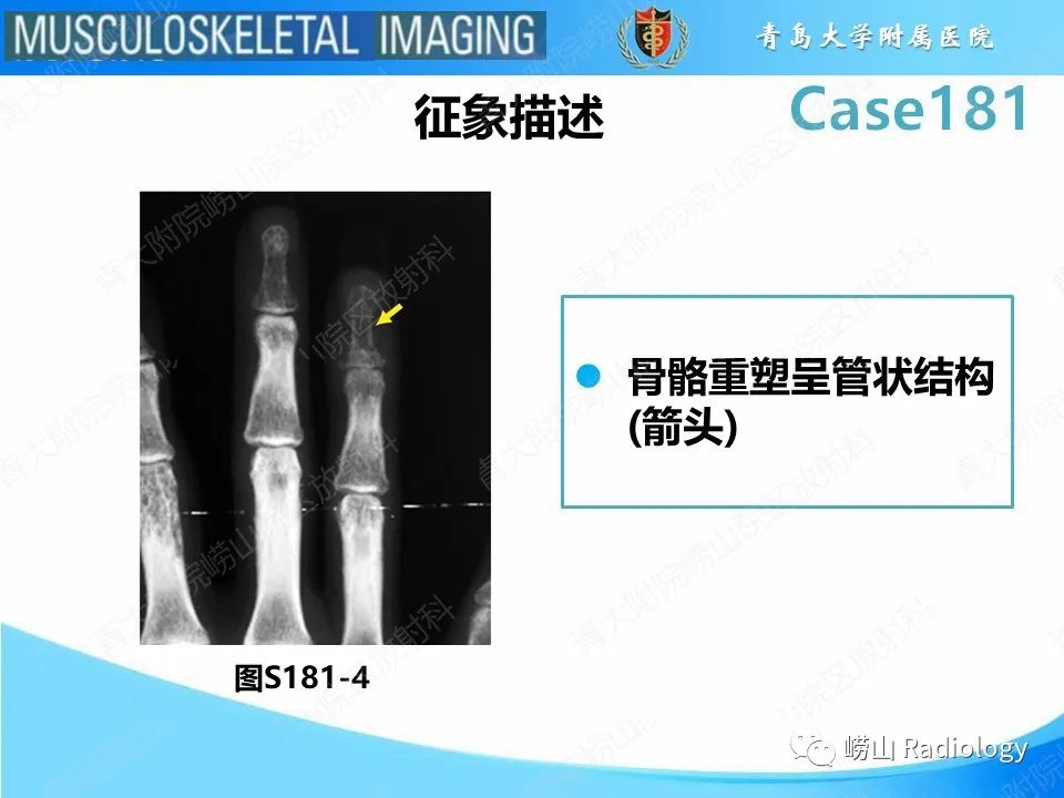 影像PPT - 【PPT】结节病性关节病-17