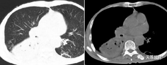 影像PPT - 肺放线菌病的 CT 影像表现-3 影像PPT - 肺放线菌病的 CT 影像表现-3