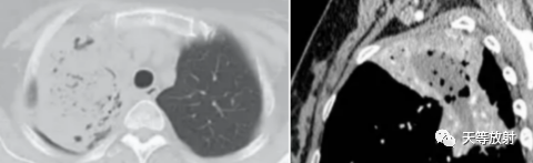 影像PPT - 肺放线菌病的 CT 影像表现-4 影像PPT - 肺放线菌病的 CT 影像表现-4