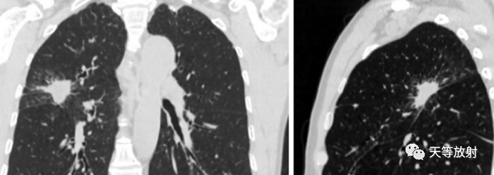 影像PPT - 肺放线菌病的 CT 影像表现-1 影像PPT - 肺放线菌病的 CT 影像表现-1