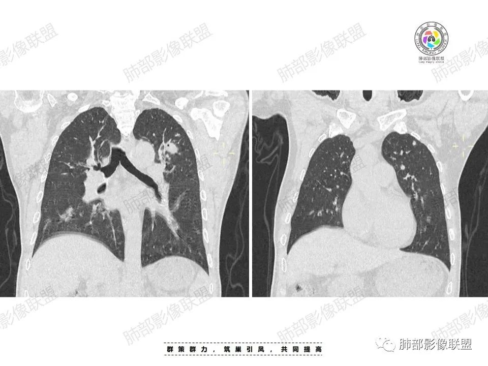 影像PPT - 【病例】肉芽肿性炎特征之一——结节融合征象-9 影像PPT - 【病例】肉芽肿性炎特征之一——结节融合征象-9