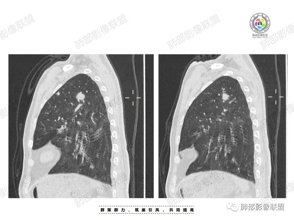 影像PPT - 【病例】肉芽肿性炎特征之一——结节融合征象-10 影像PPT - 【病例】肉芽肿性炎特征之一——结节融合征象-10
