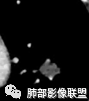 影像PPT - 【病例】肉芽肿性炎特征之一——结节融合征象-17 影像PPT - 【病例】肉芽肿性炎特征之一——结节融合征象-17