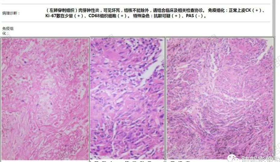 影像PPT - 【病例】肉芽肿性炎特征之一——结节融合征象-20 影像PPT - 【病例】肉芽肿性炎特征之一——结节融合征象-20
