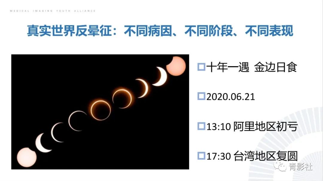 影像PPT - 【PPT】肺部反晕征影像诊断思维-4
