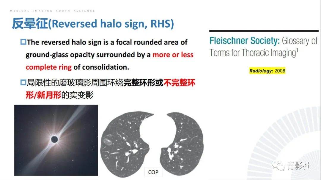 影像PPT - 【PPT】肺部反晕征影像诊断思维-3