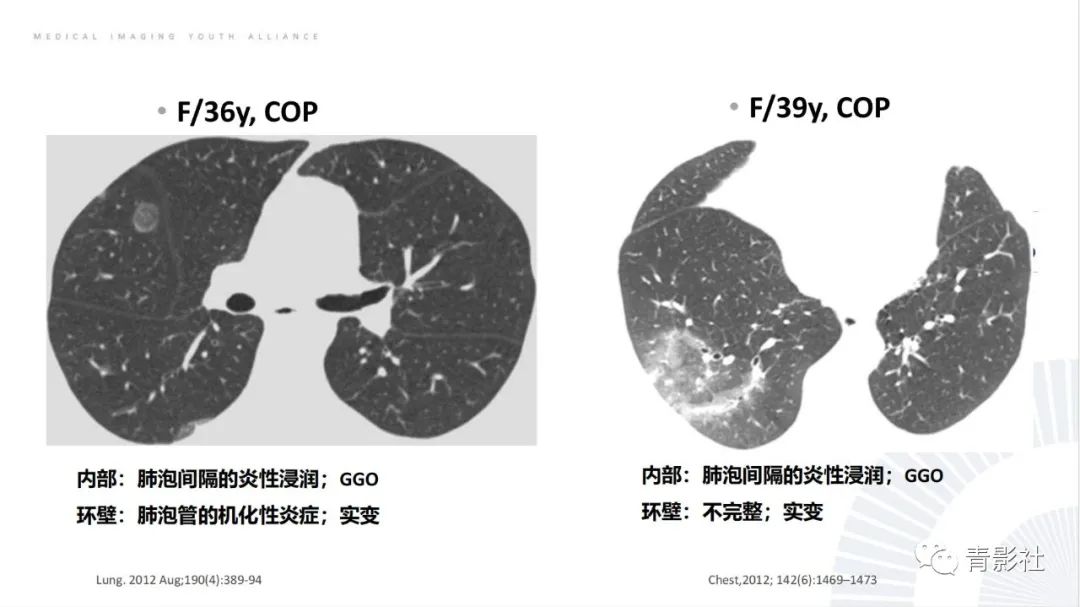 影像PPT - 【PPT】肺部反晕征影像诊断思维-13
