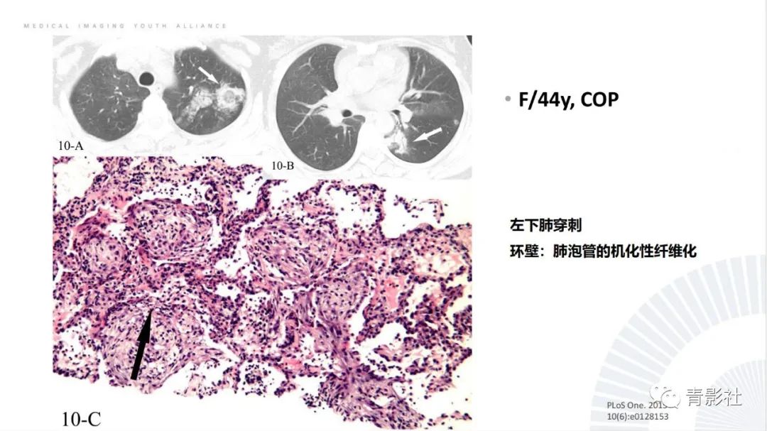 影像PPT - 【PPT】肺部反晕征影像诊断思维-14