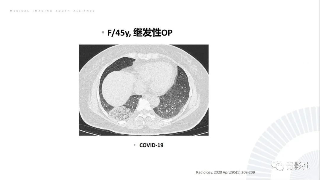 影像PPT - 【PPT】肺部反晕征影像诊断思维-15