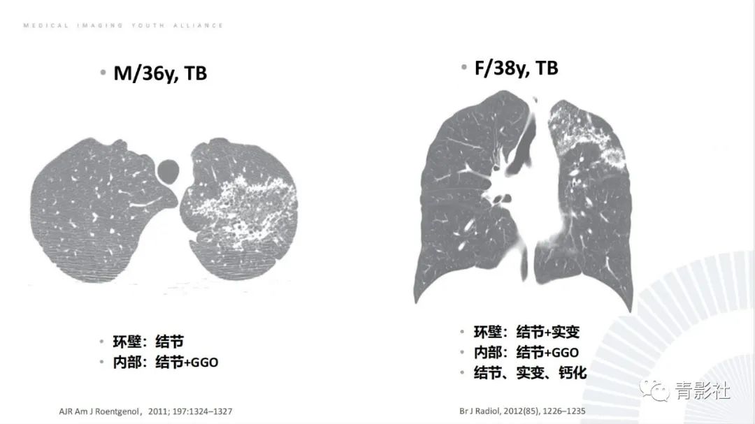 影像PPT - 【PPT】肺部反晕征影像诊断思维-19