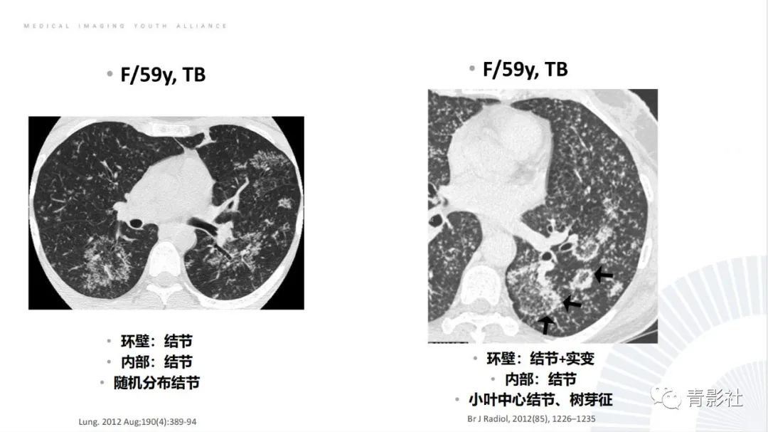 影像PPT - 【PPT】肺部反晕征影像诊断思维-18