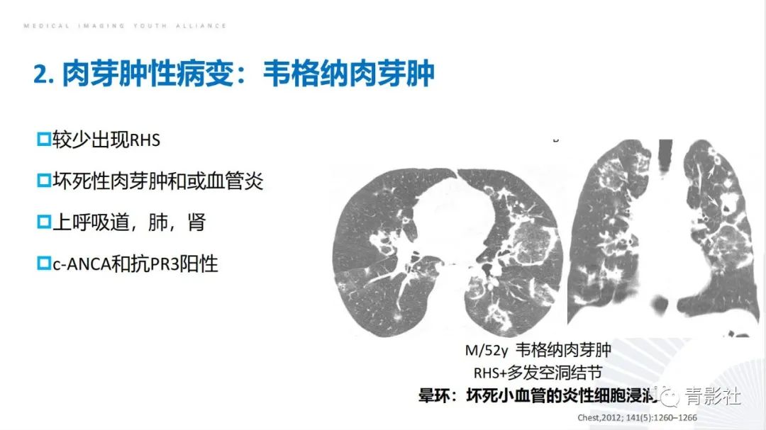 影像PPT - 【PPT】肺部反晕征影像诊断思维-33