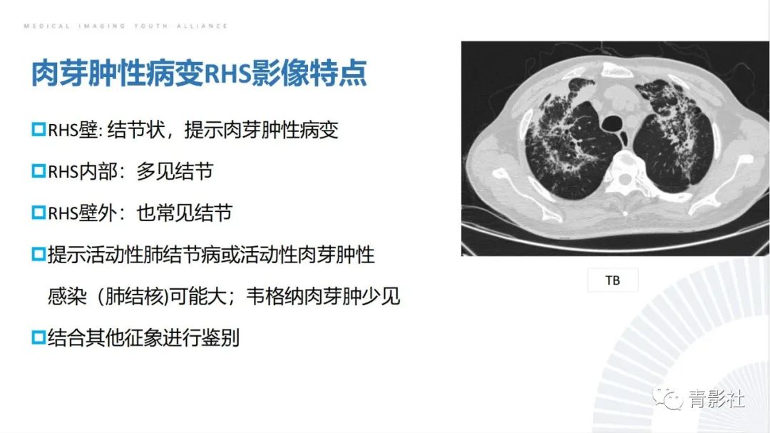 影像PPT - 【PPT】肺部反晕征影像诊断思维-34
