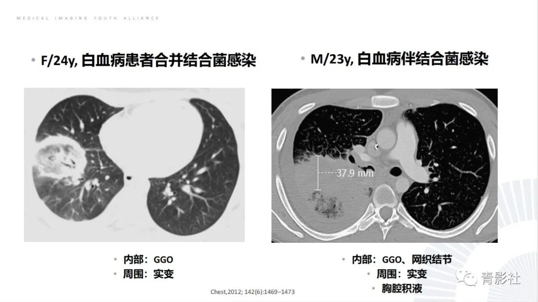 影像PPT - 【PPT】肺部反晕征影像诊断思维-36