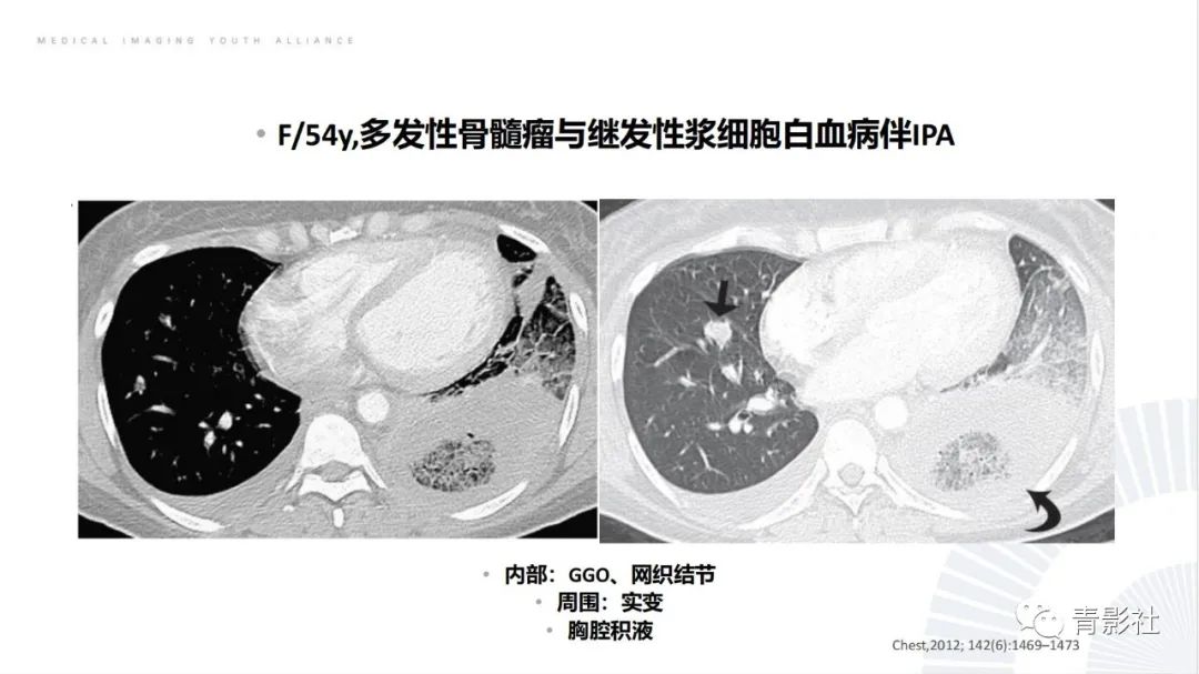 影像PPT - 【PPT】肺部反晕征影像诊断思维-38