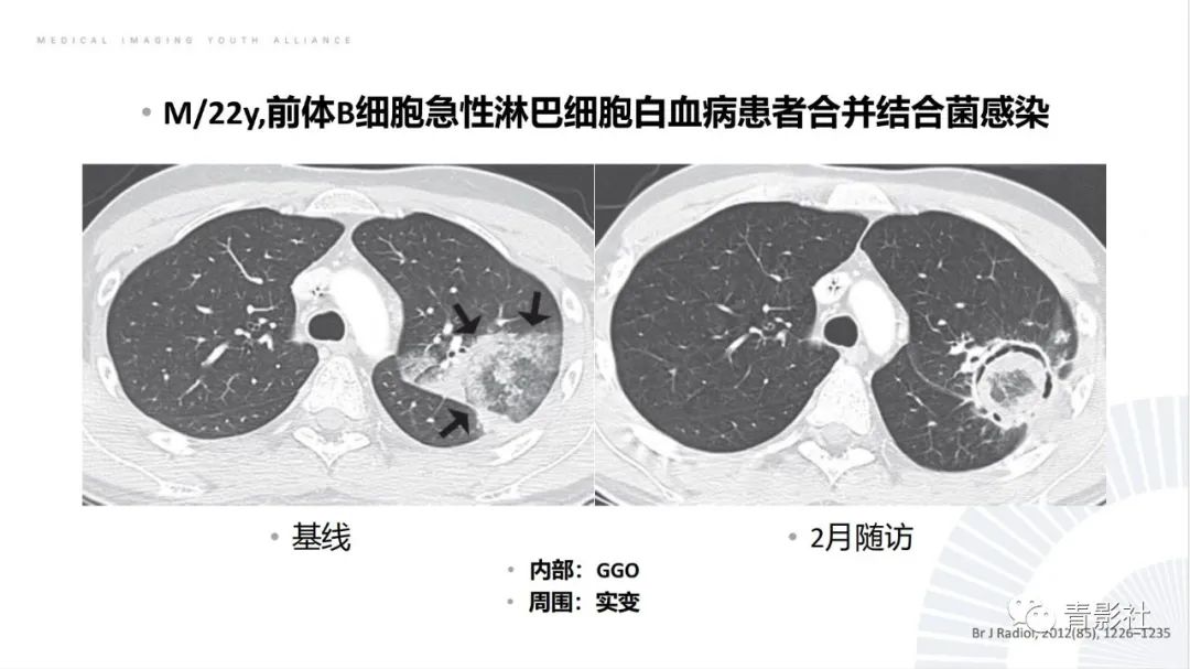 影像PPT - 【PPT】肺部反晕征影像诊断思维-37