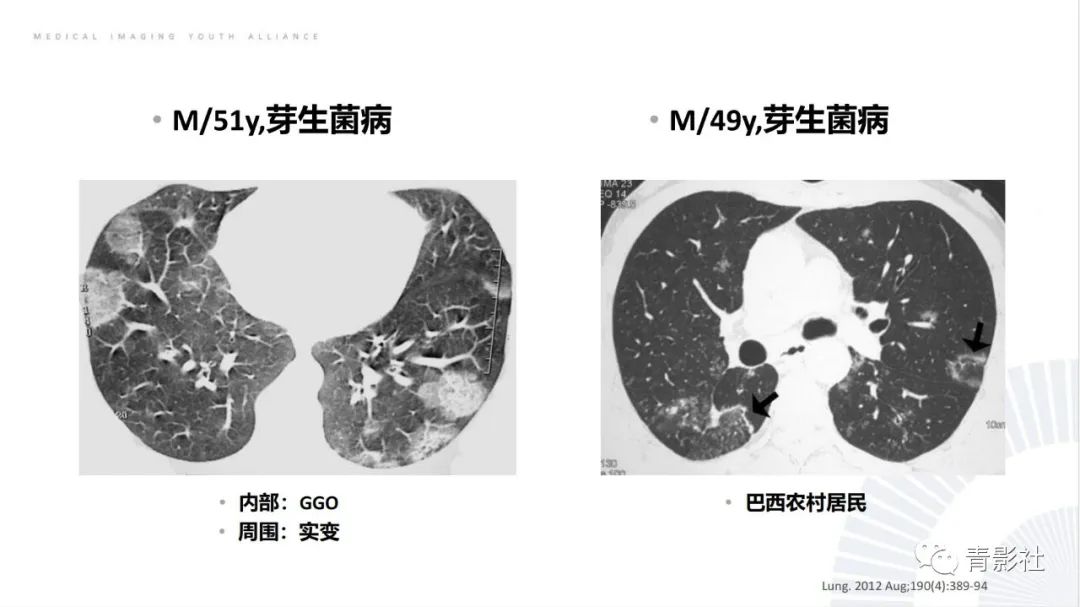 影像PPT - 【PPT】肺部反晕征影像诊断思维-40